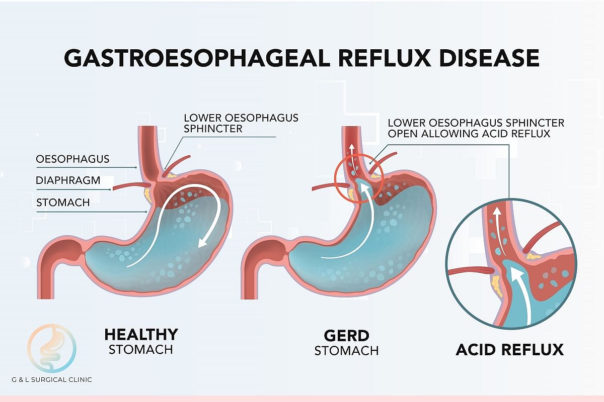 Acid reflux symptoms