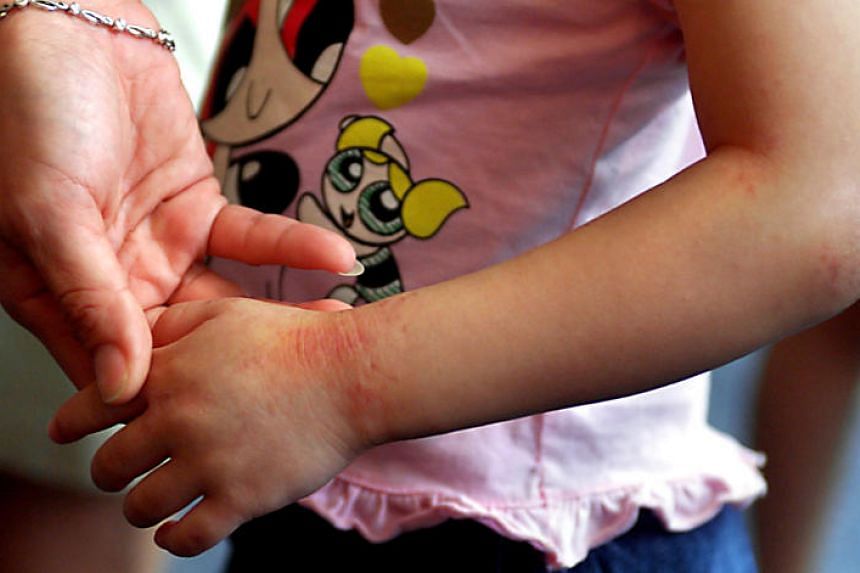 At Least 1 In 5 School Going Kids Here Have Eczema Cases Could Rise